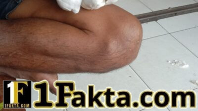 Cedera Akibat Mesin, Legalitas dan Keselamatan Pekerja di Bekasi Dipertanyakan